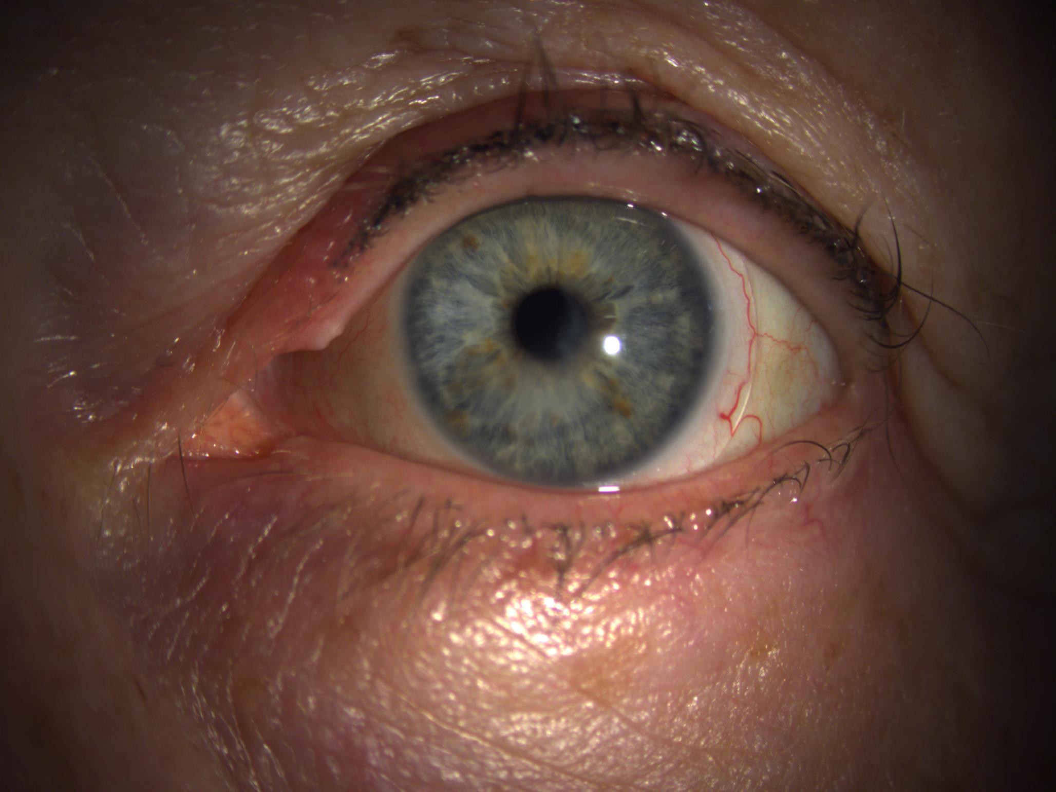 Sklerallinse auf dem Auge bei komplexer Augenoberfläche